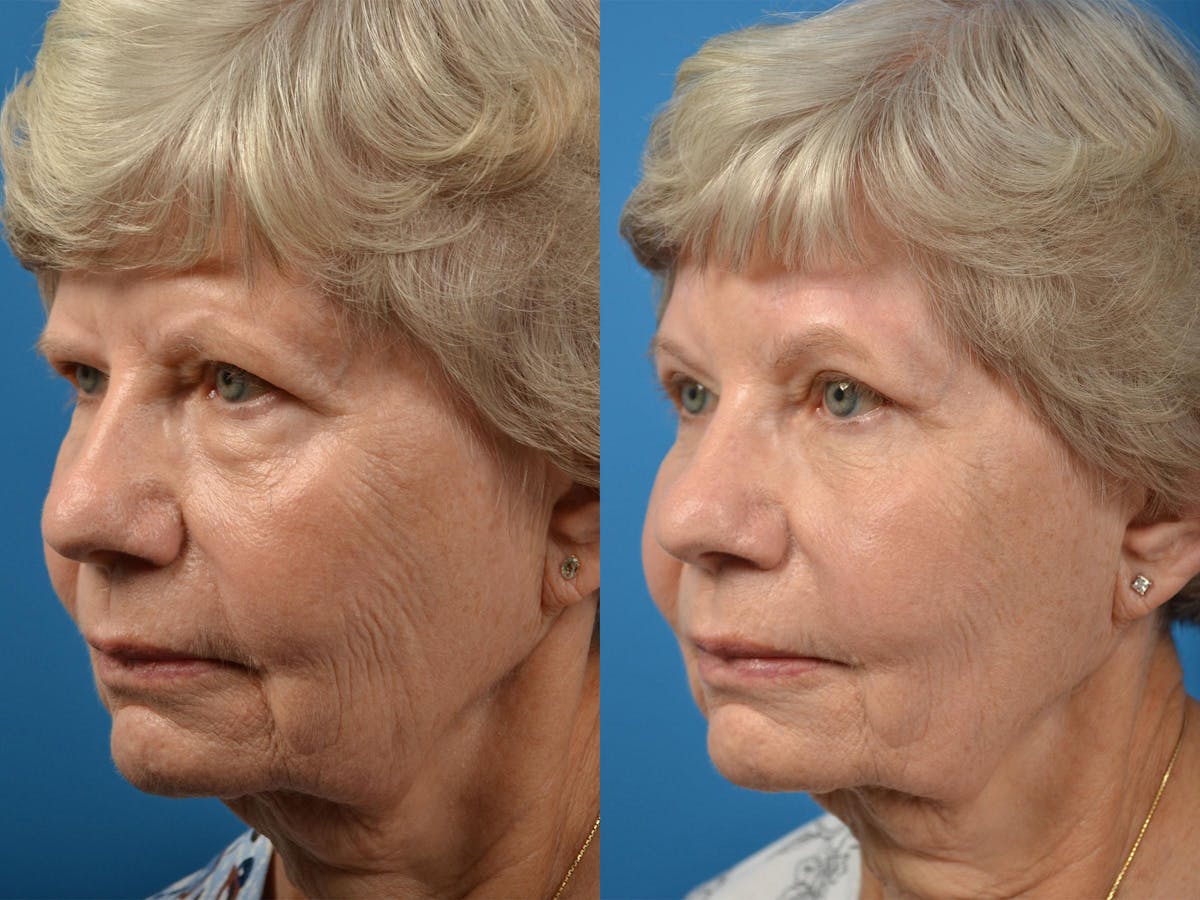 Brow Lift Before & After Gallery - Patient 122405475 - Image 4
