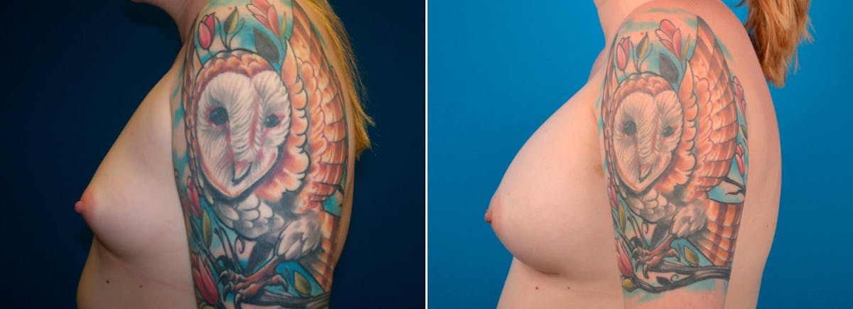 Breast Augmentation Before & After Gallery - Patient 250413 - Image 3