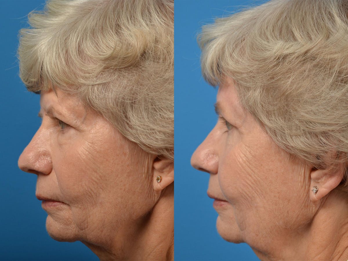 Brow Lift Before & After Gallery - Patient 122405475 - Image 5