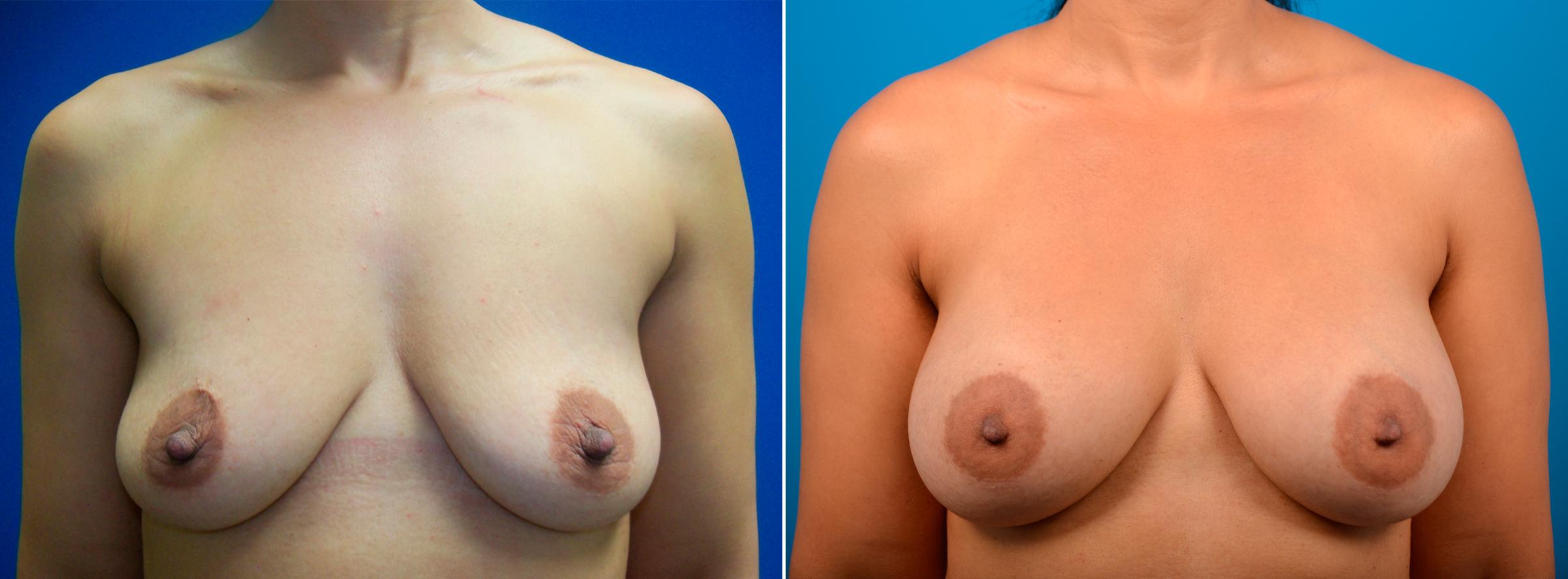 Hidden Breast Aug Before & After Gallery - Patient 352091 - Image 1