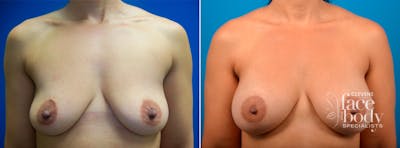 Hidden Breast Aug Before & After Gallery - Patient 253262 - Image 1