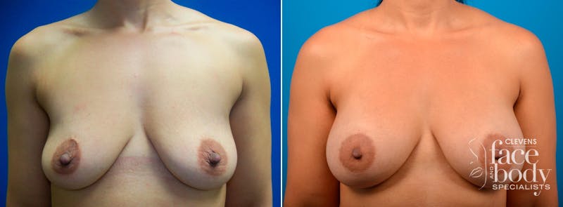 Hidden Breast Aug Before & After Gallery - Patient 352091 - Image 1