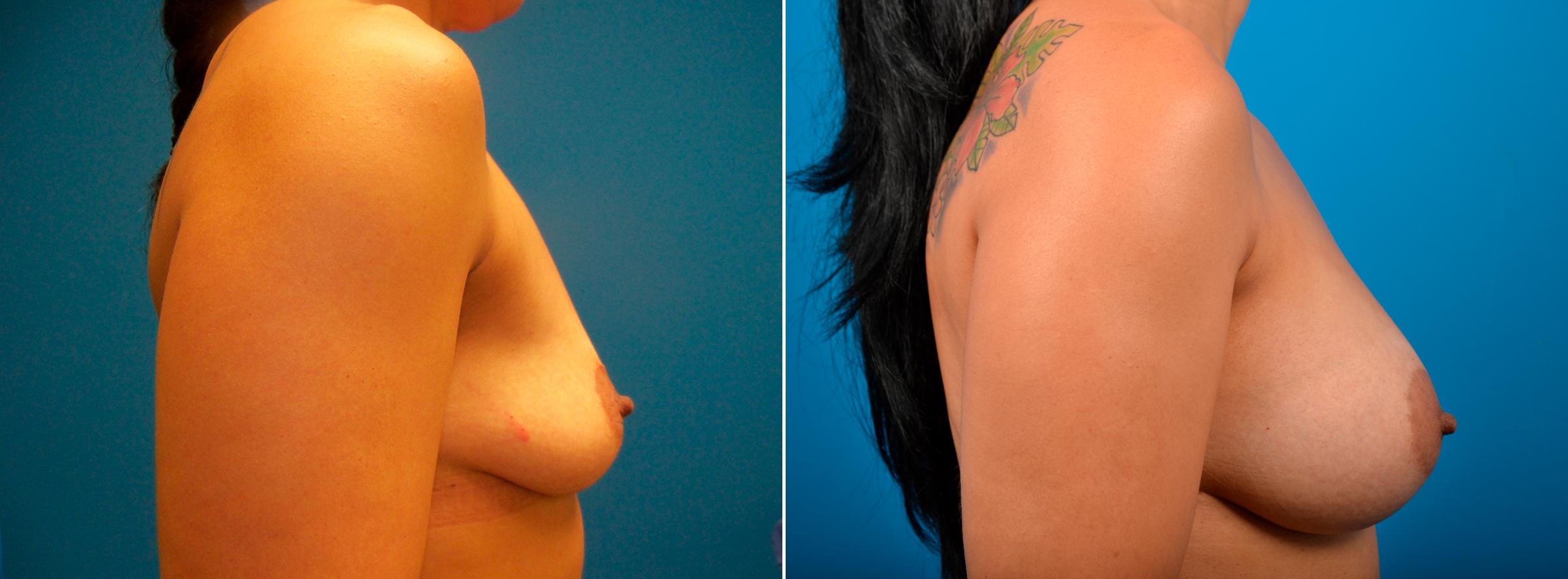 Hidden Breast Aug Before & After Gallery - Patient 352091 - Image 2