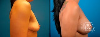 Hidden Breast Aug Before & After Gallery - Patient 352091 - Image 2