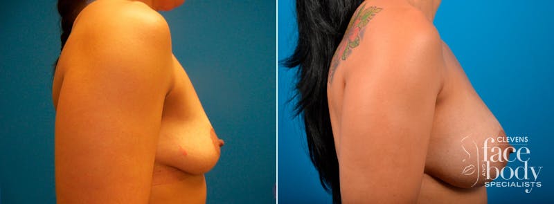 Hidden Breast Aug Before & After Gallery - Patient 352091 - Image 2