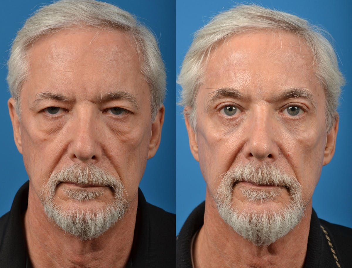 Brow Lift Before & After Gallery - Patient 122405478 - Image 1