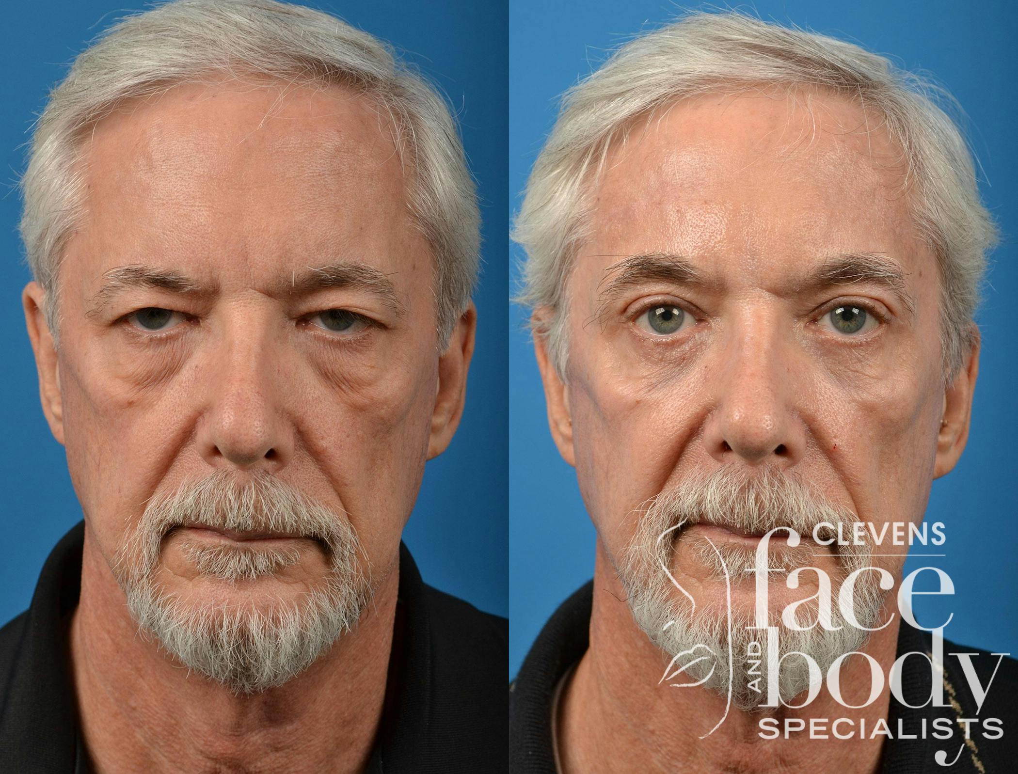 Brow Lift