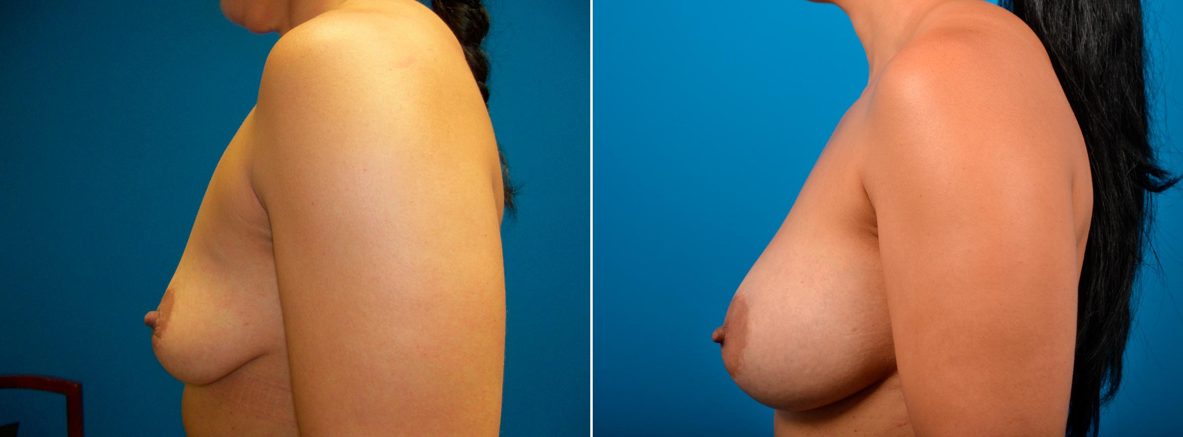 Hidden Breast Aug Before & After Gallery - Patient 352091 - Image 3