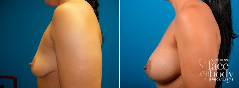 Hidden Breast Aug Before & After Gallery - Patient 352091 - Image 3
