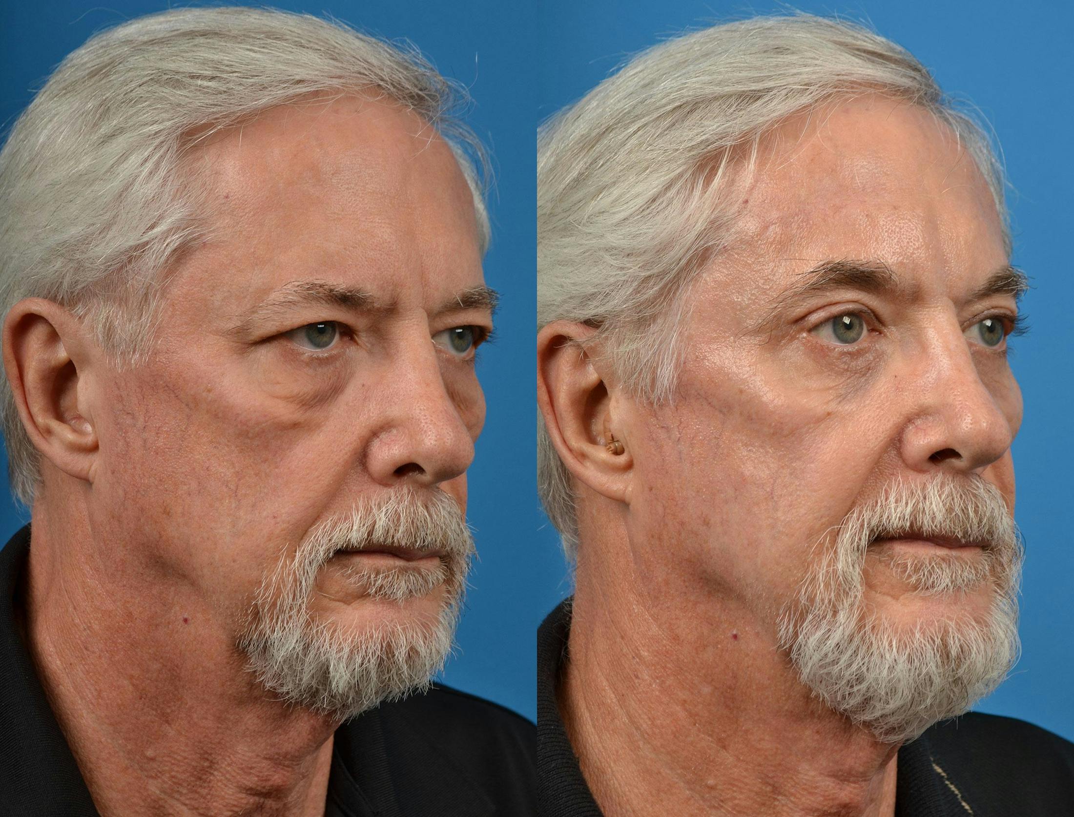 Brow Lift Before & After Gallery - Patient 122405478 - Image 2