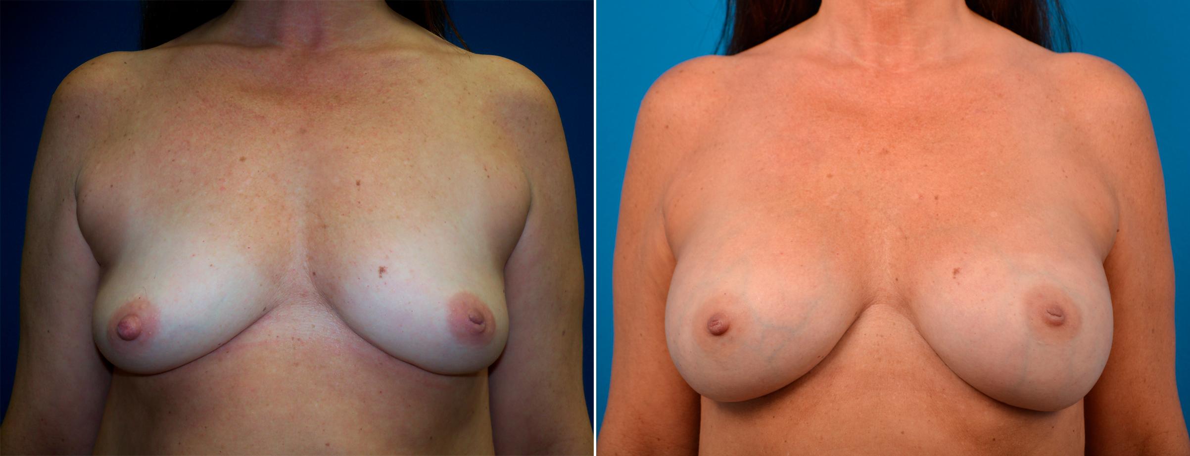 Hidden Breast Aug Before & After Gallery - Patient 385396 - Image 1