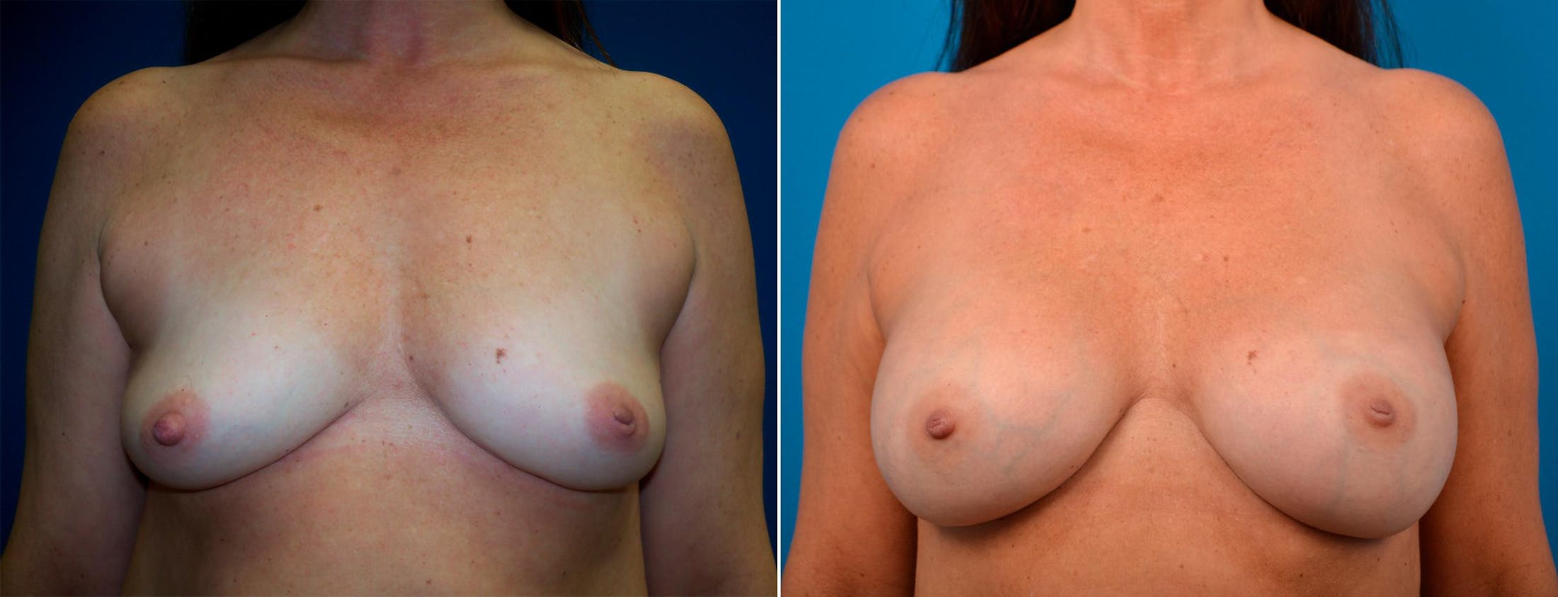 Breast Augmentation Before & After Gallery - Patient 122405477 - Image 1