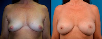 Breast Augmentation Before & After Gallery - Patient 338020 - Image 1