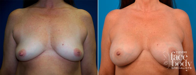 Hidden Breast Aug Before & After Gallery - Patient 370243 - Image 1