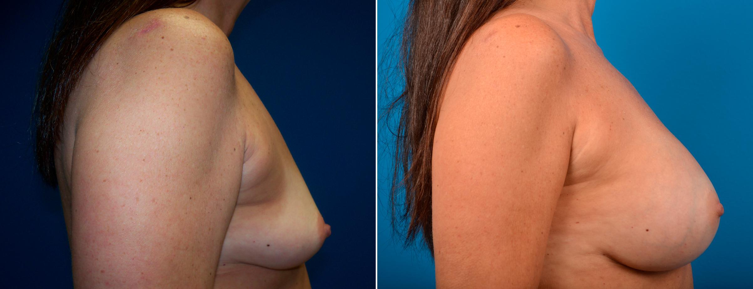 Hidden Breast Aug Before & After Gallery - Patient 385396 - Image 2
