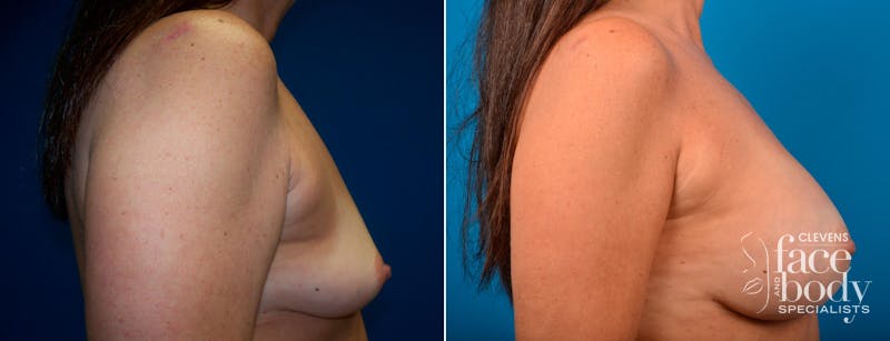 Hidden Breast Aug Before & After Gallery - Patient 370243 - Image 2