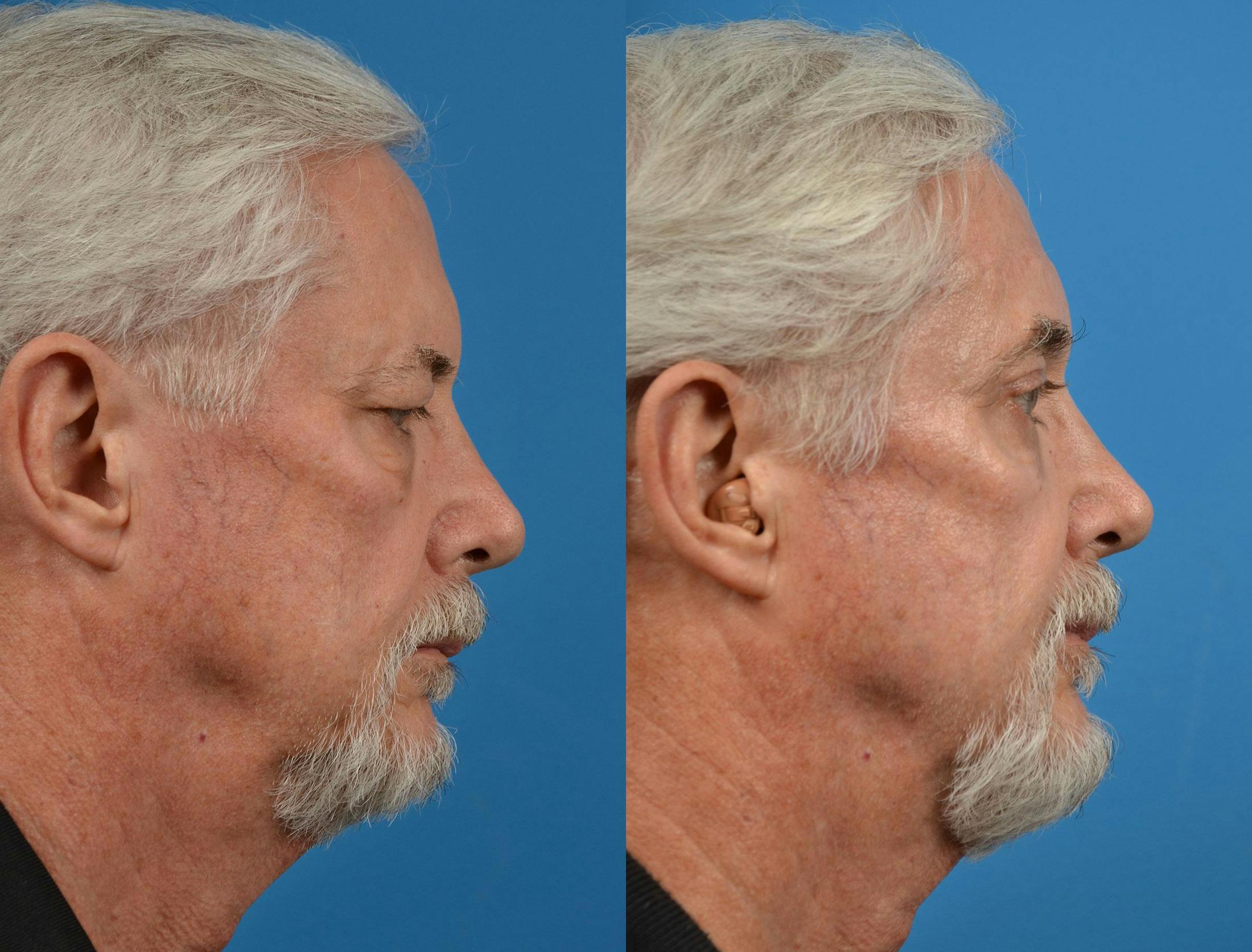 Brow Lift Before & After Gallery - Patient 122405478 - Image 3