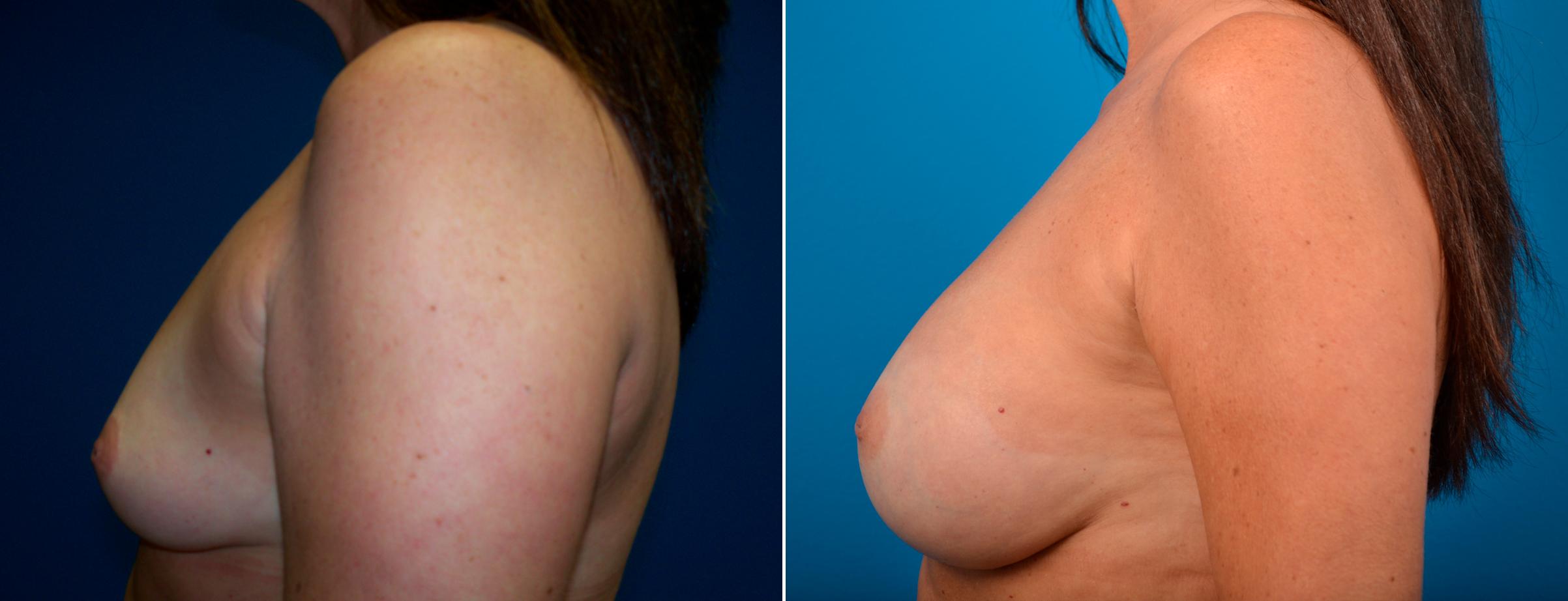 Hidden Breast Aug Before & After Gallery - Patient 385396 - Image 3