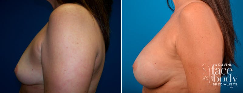 Hidden Breast Aug Before & After Gallery - Patient 370243 - Image 3