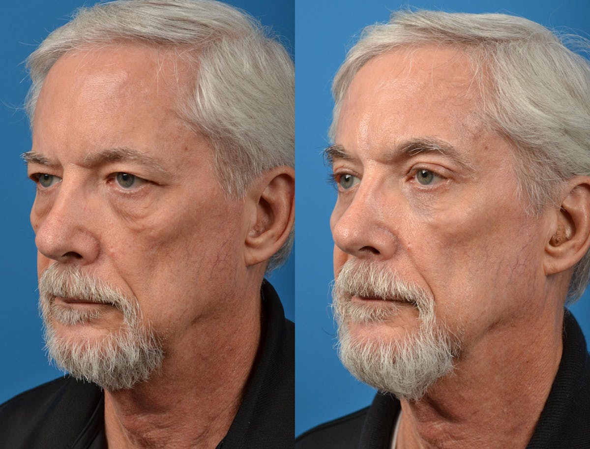 Brow Lift Before & After Gallery - Patient 122405478 - Image 4