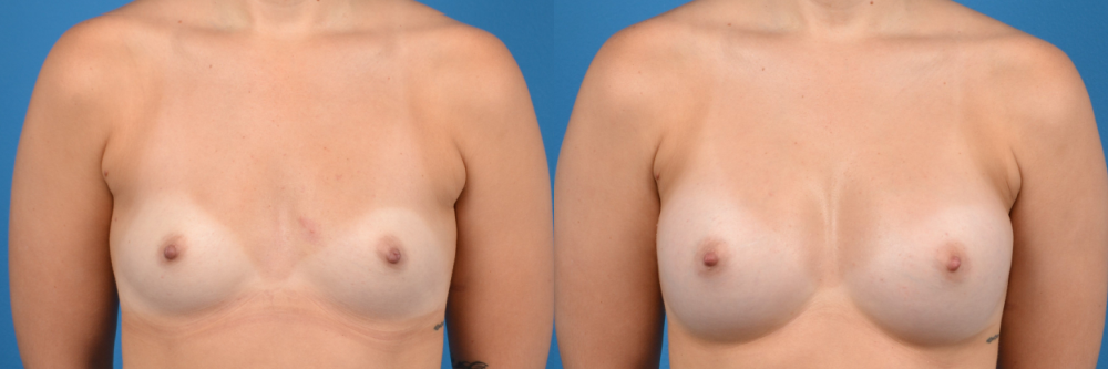 Hidden Breast Aug Before & After Gallery - Patient 262374 - Image 1