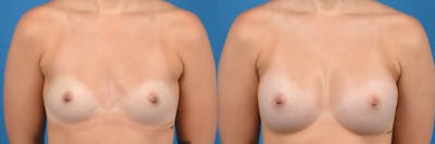 Breast Augmentation Before & After Gallery - Patient 137294 - Image 1