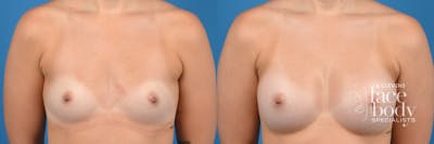 Hidden Breast Aug Before & After Gallery - Patient 411472 - Image 1
