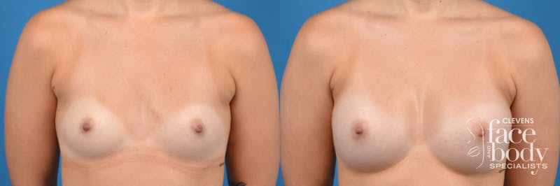 Hidden Breast Aug Before & After Gallery - Patient 262374 - Image 1