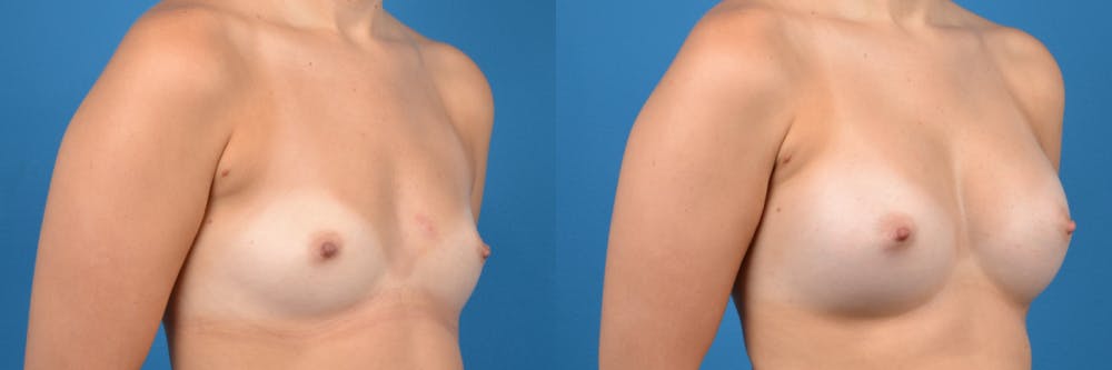 Breast Augmentation Before & After Gallery - Patient 122405481 - Image 3