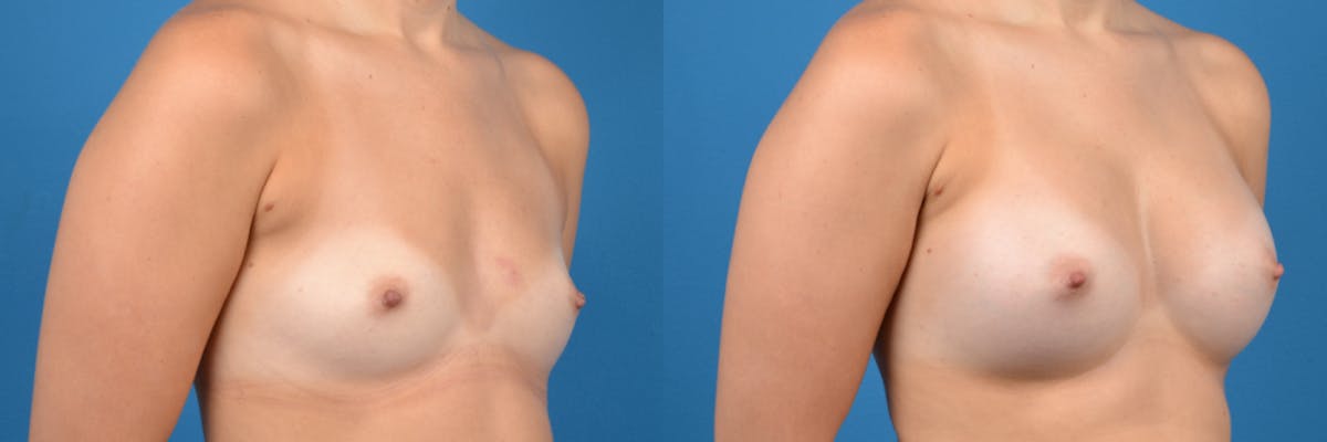 Breast Augmentation Before & After Gallery - Patient 137294 - Image 3