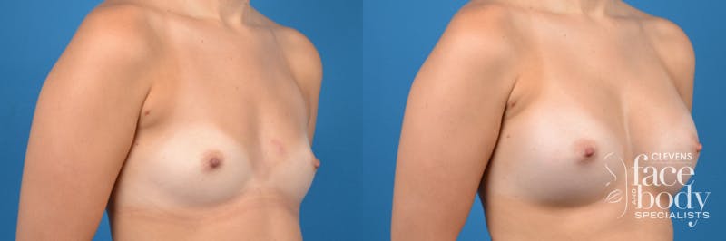 Hidden Breast Aug Before & After Gallery - Patient 262374 - Image 3