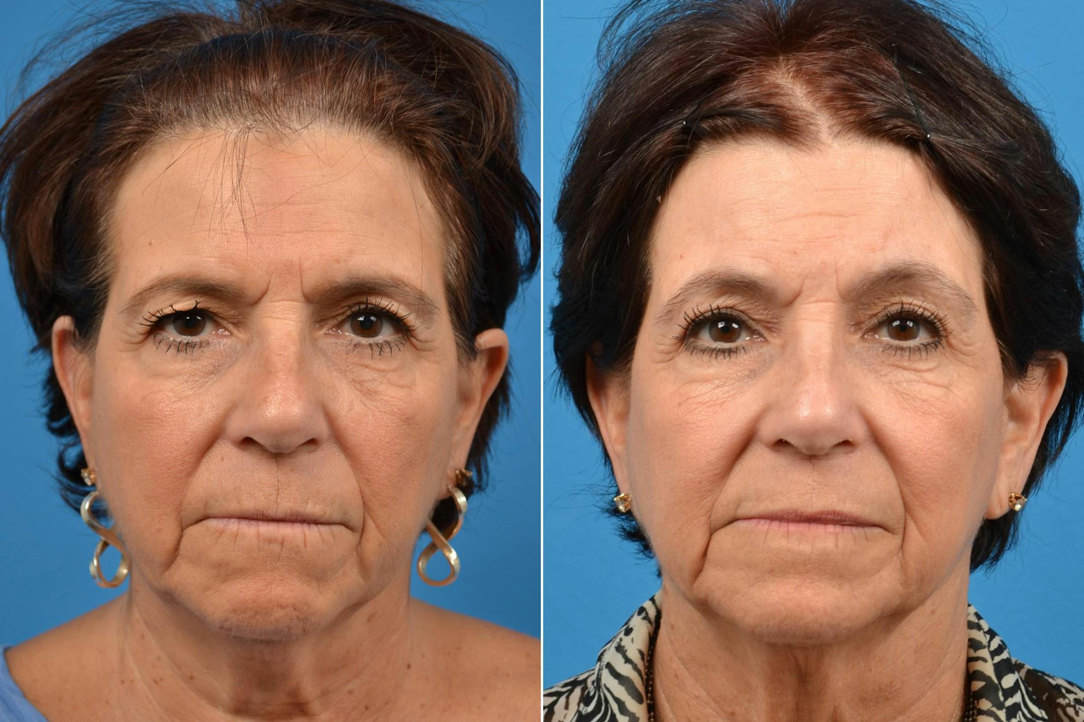 Brow Lift Before & After Gallery - Patient 122405487 - Image 1