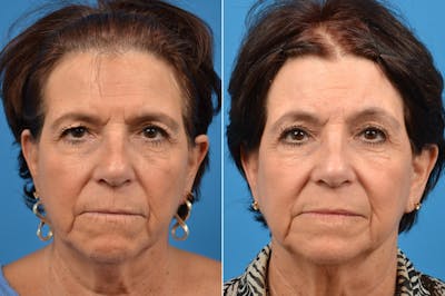 Brow Lift Before & After Gallery - Patient 122405487 - Image 1
