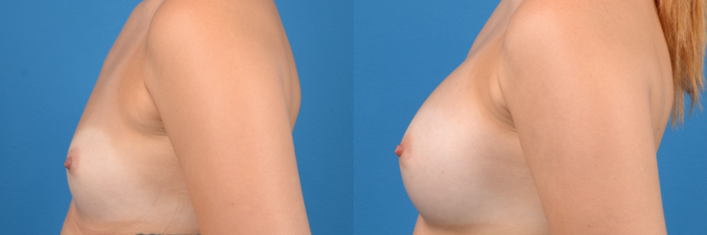 Hidden Breast Aug Before & After Gallery - Patient 262374 - Image 4