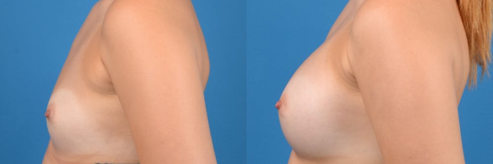 Breast Augmentation Before & After Gallery - Patient 122405481 - Image 4