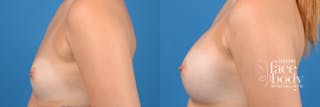 Hidden Breast Aug Before & After Gallery - Patient 262374 - Image 4