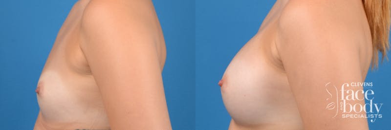 Hidden Breast Aug Before & After Gallery - Patient 262374 - Image 4