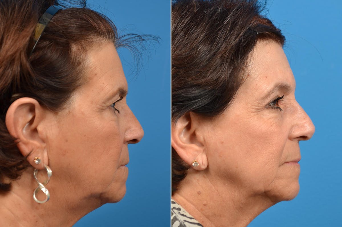 Brow Lift Before & After Gallery - Patient 122405487 - Image 2