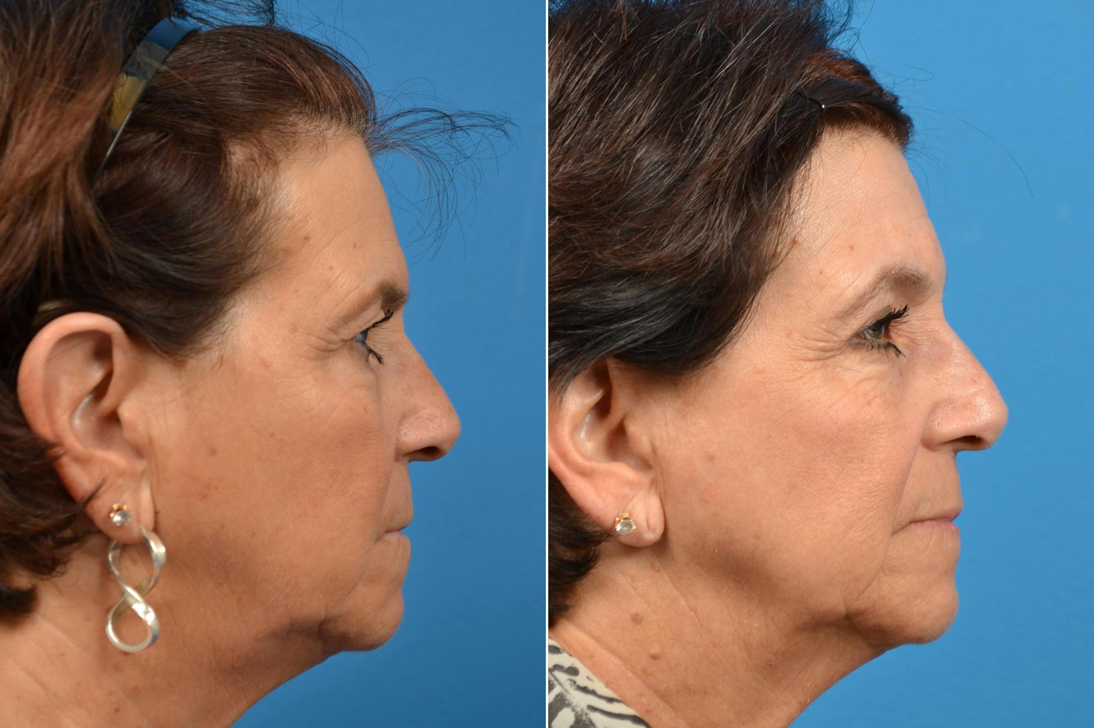 Brow Lift Before & After Gallery - Patient 122405487 - Image 2