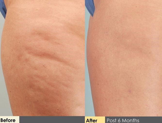Hidden Cellulite Reduction Before & After Gallery - Patient 122405480 - Image 1