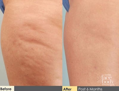 Hidden Cellulite Reduction Before & After Gallery - Patient 122405480 - Image 1
