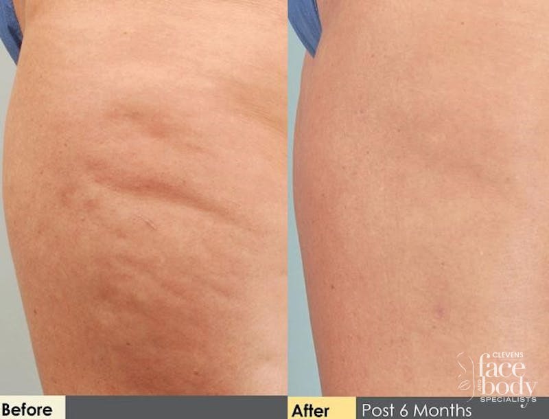 Hidden Cellulite Reduction Before & After Gallery - Patient 122405480 - Image 1