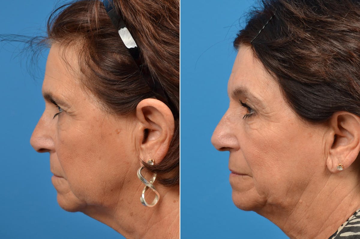 Brow Lift Before & After Gallery - Patient 122405487 - Image 3