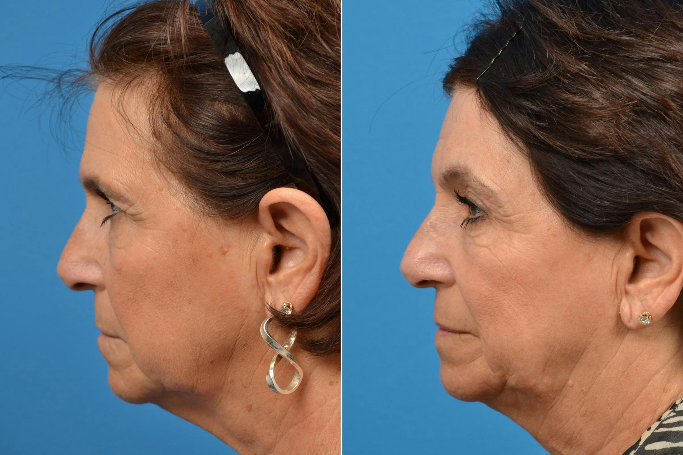 Brow Lift Before & After Gallery - Patient 122405487 - Image 3