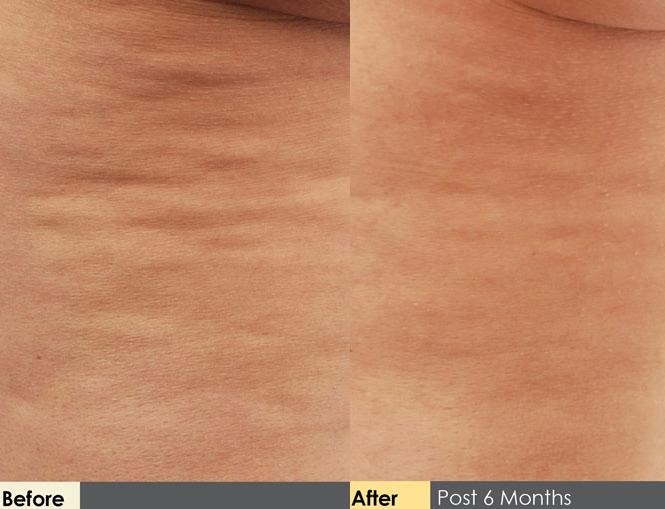Hidden Cellulite Reduction Before & After Gallery - Patient 122405482 - Image 1