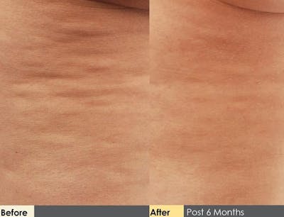 Cellulite Reduction Before & After Gallery - Patient 122405482 - Image 1