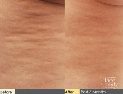 Hidden Cellulite Reduction Before & After Gallery - Patient 122405482 - Image 1