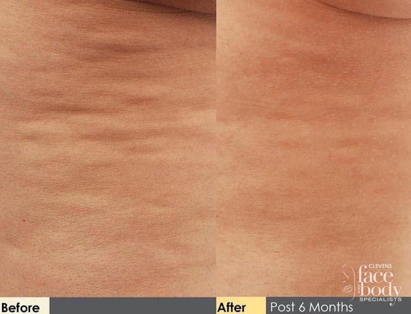 Hidden Cellulite Reduction Before & After Gallery - Patient 122405482 - Image 1