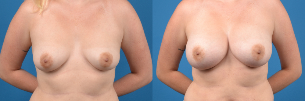 Hidden Breast Aug Before & After Gallery - Patient 244381 - Image 1