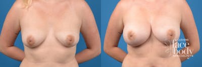 Hidden Breast Aug Before & After Gallery - Patient 419785 - Image 1